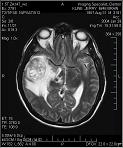 Compare 11.18.05 MRI to 1.29.04 MRI